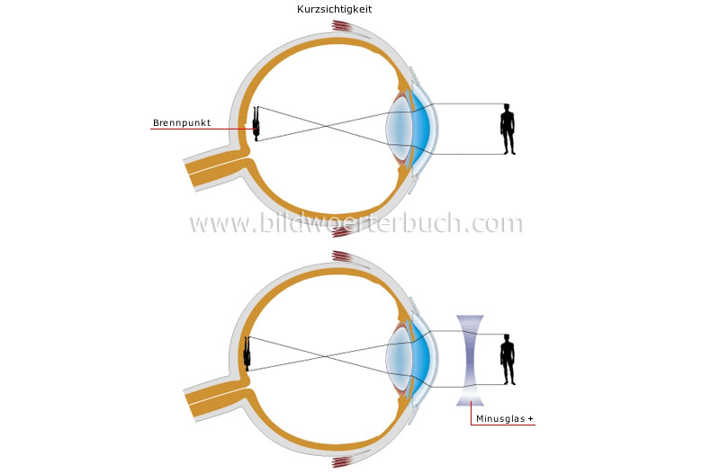 vision defects image