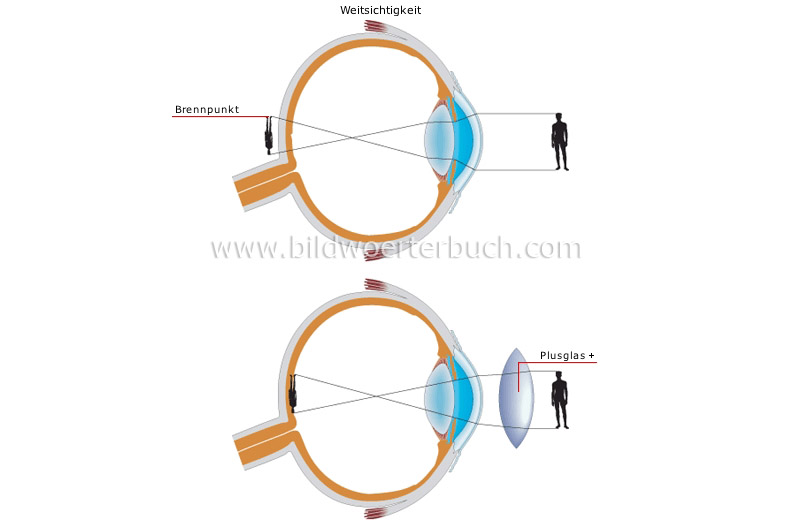 vision defects image