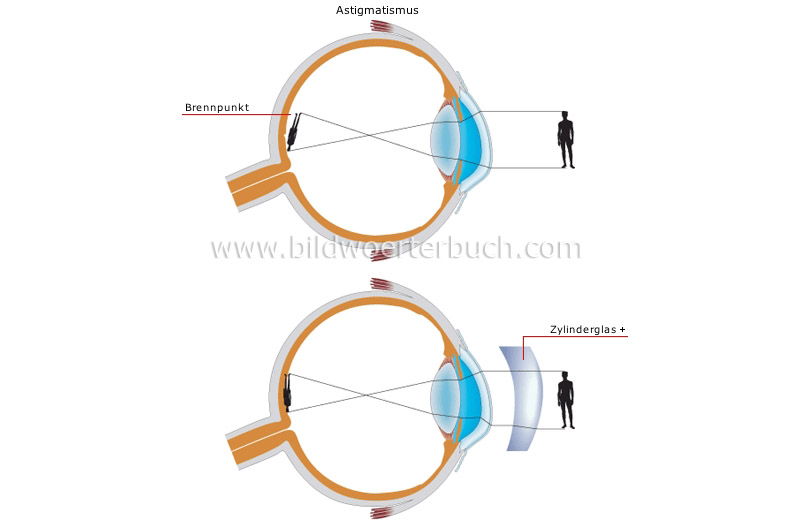 vision defects image